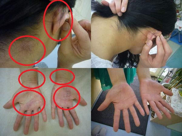 アトピーbefore-after