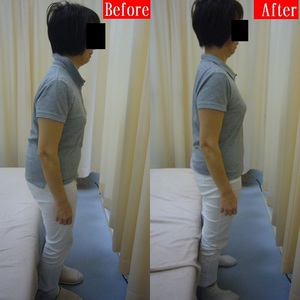 ぎっくり腰のビフォア・アフター2