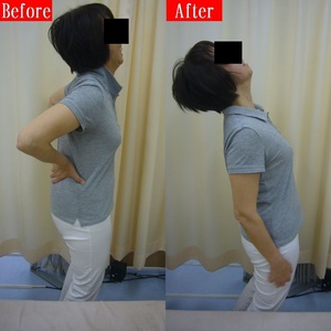 ぎっくり腰のビフォア・アフター